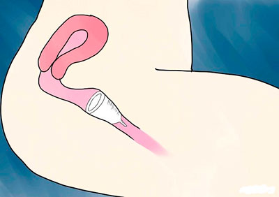 Проверните менструальную чашу